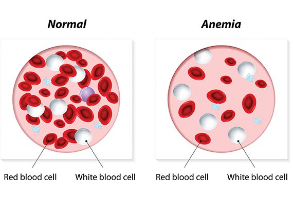 Anaemia