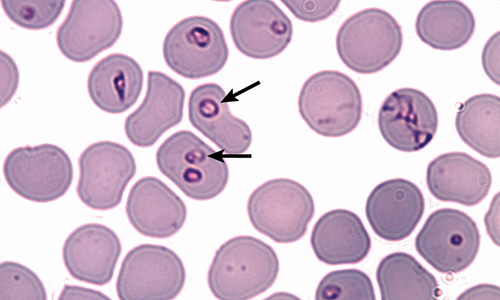 Babesiosis