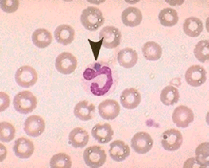 Ehrlichiosis